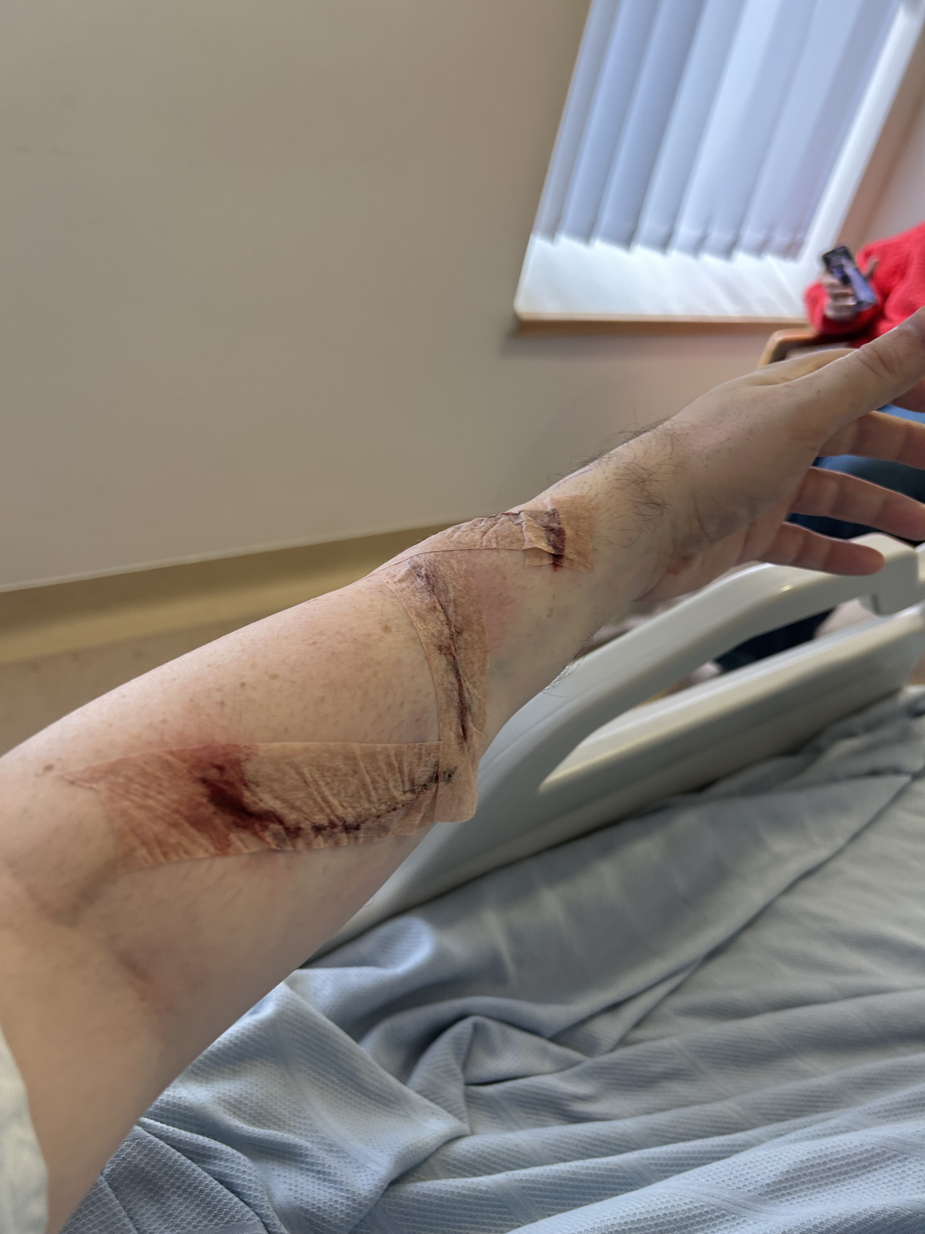 Scar Numbers Operation Day (Number 2) – Proud of my Scar